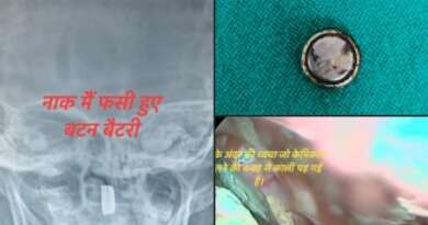 चम्पावत : मासूम के नाक में फंसी बटन बैटरी, जिला अस्पताल के डॉक्टर ने दिया नया जीवन