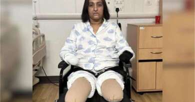 कुत्ते का केवल चाटना ही कितना खतनाक, देख लें…महिला को हुई खतरनाक बीमारी सेप्सिस, काटने पड़े हाथ पैर, 6 बार दिल का दौरा पड़ा